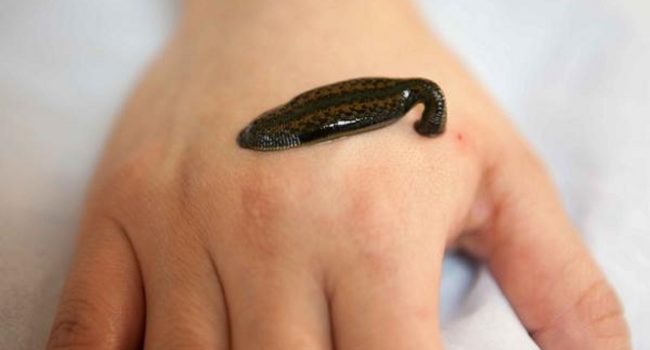 Leech therapy